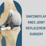 Unicondylar Knee Joint Replacement Surgery