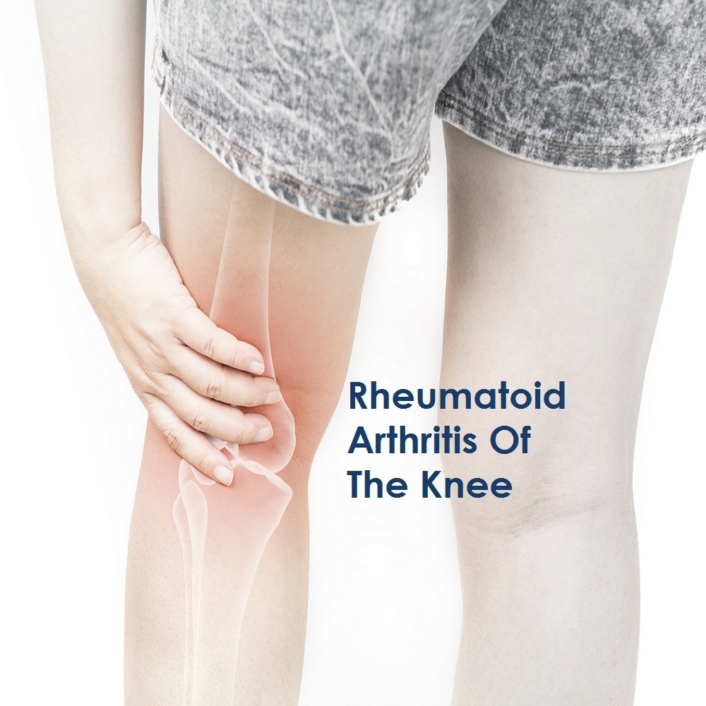 Rheumatoid Arthritis Of The Knee