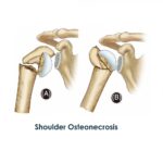 Shoulder Osteonecrosis