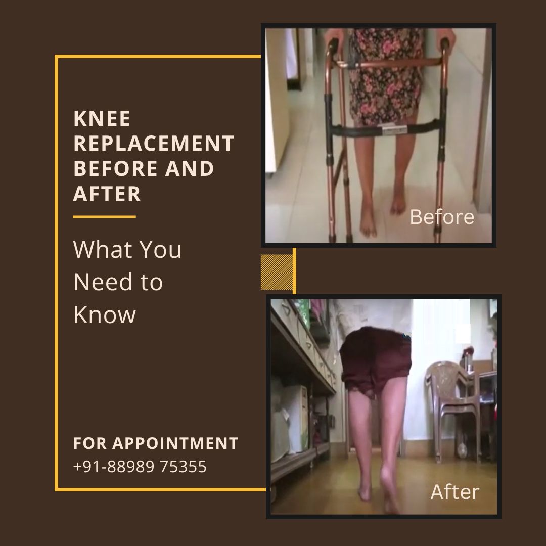 Knee Replacement Before and After - What You Need to Know