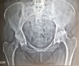 Total Hip Replacement Pre Operation
