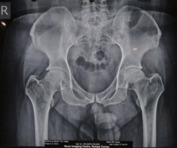 Total Hip Replacement Pre Operation