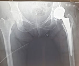 Total Hip Replacement Post Operation