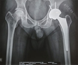 Total Hip Replacement Post Operation