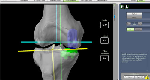 Robotic Partial Knee Replacement Planning