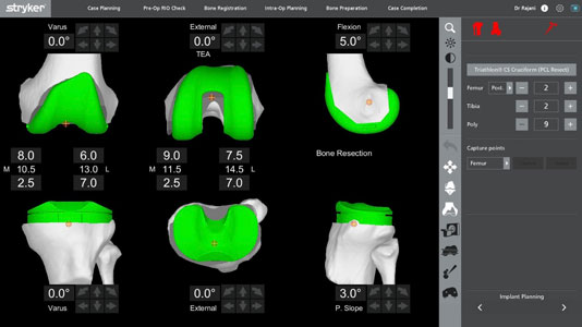 Robotic Total Knee Replacement Planning