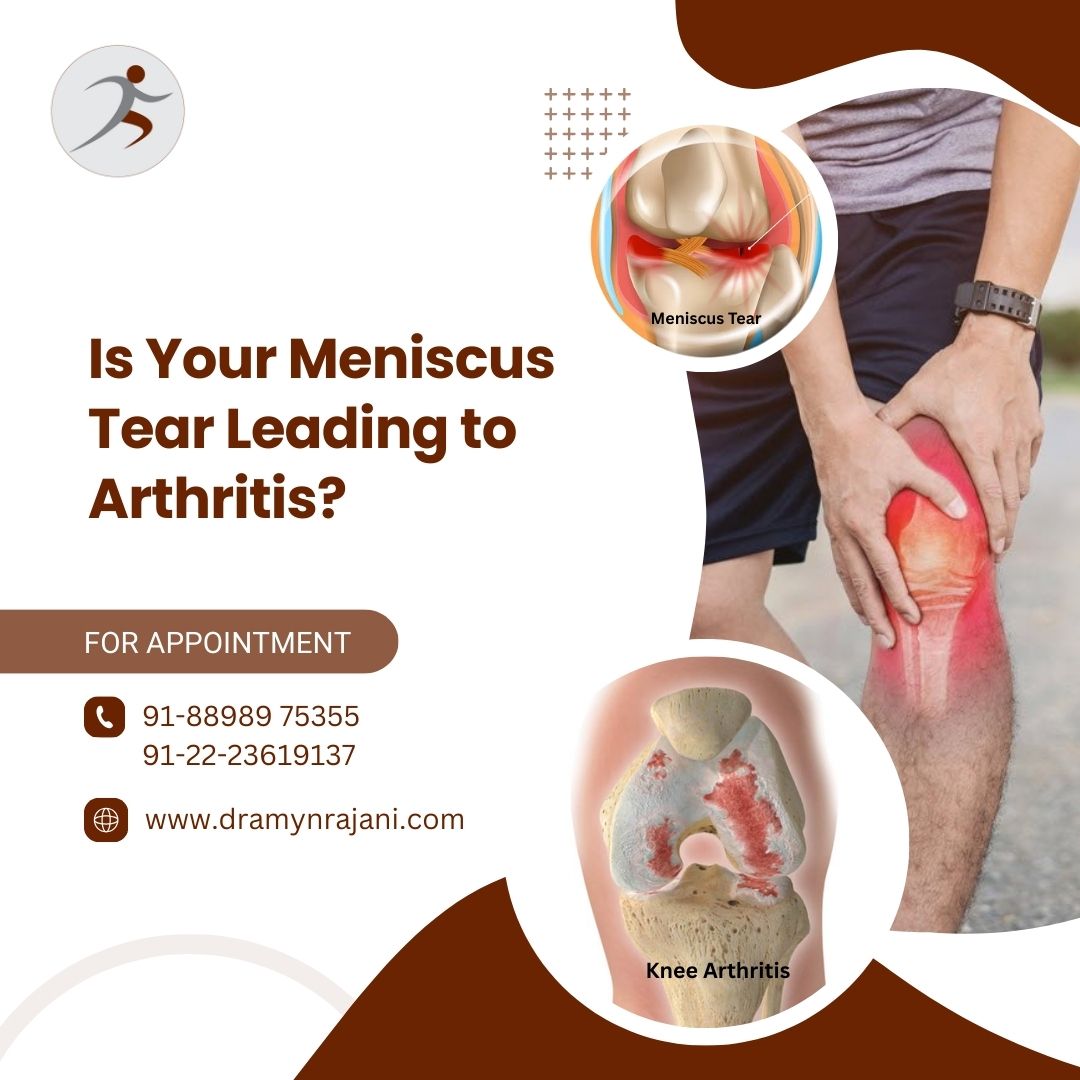 Is Your Meniscus Tear Leading to Arthritis