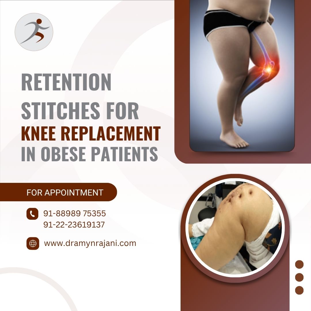 Retention Stitches for Knee Replacement in Obese Patients